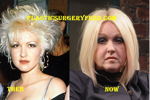 Cyndi Lauper Facelift and Botox