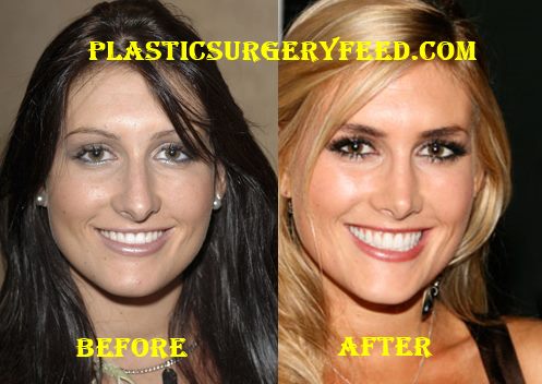 Jen Bunney Nose Job Rhinoplasty - Jen-Bunney-Nose-Job-Rhinoplasty