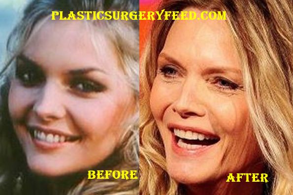 Michelle Pfeiffer Plastic Surgery Plastic Surgery Feed