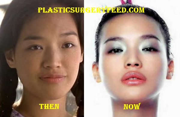 Shu Qi Lips Surgery Augmentation