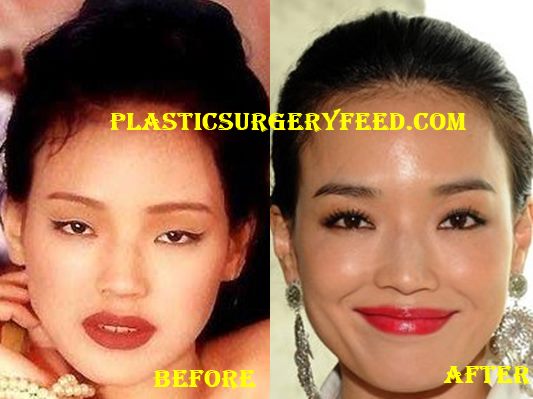 Shu Qi Nose Job Rhinoplasty - Shu-Qi-Nose-Job-Rhinoplasty