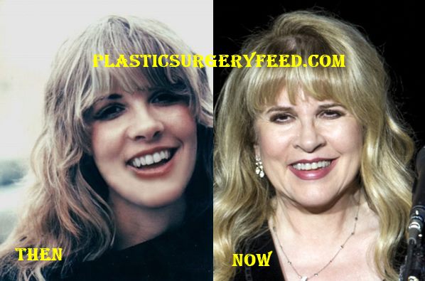 Stevie Nicks Botox and Facelift