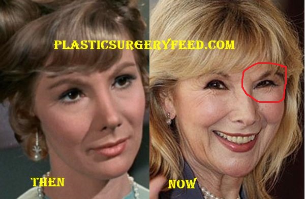 Susan Hampshire Botox Plastic Surgery