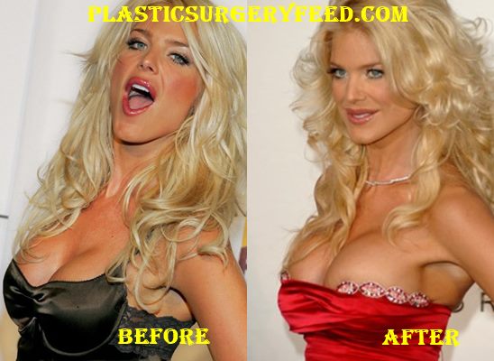 Victoria Silvstedt Breast Implants