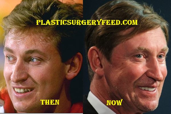 Wayne Gretzky Botox Surgery