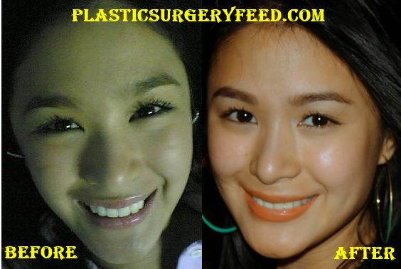 Heart Evangelista Didn't Have Cosmetic Surgery On Her Face 