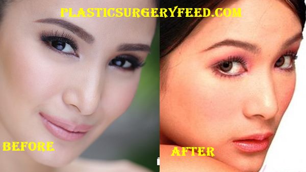 heart evangelista before and after｜TikTok Search