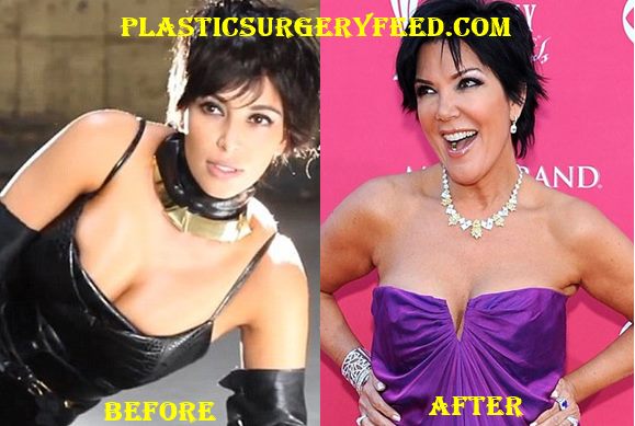 Kris Jenner Breast Implants