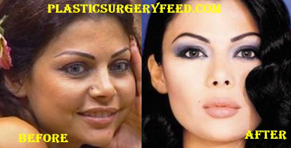 Haifa Wehbe Botox Facelift