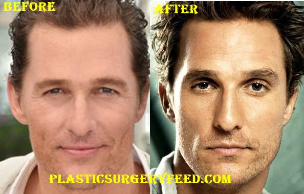 Matthew Mcconaughey Hairloss