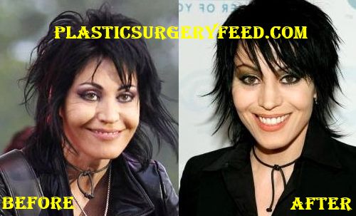 Joan Jett Cheeks Implant