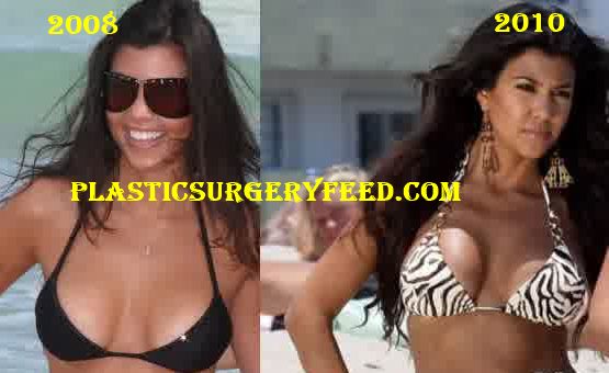 Kim Kardashian Breast Implants Boobs Job