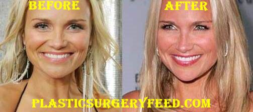 Kristin Chenoweth Botox