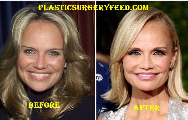 Kristin Chenoweth Cheeks Implant