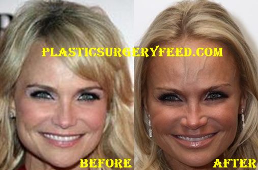 Kristin Chenoweth Nose Job Rhinoplasty