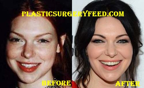 Laura Prepon Facelift and Botox