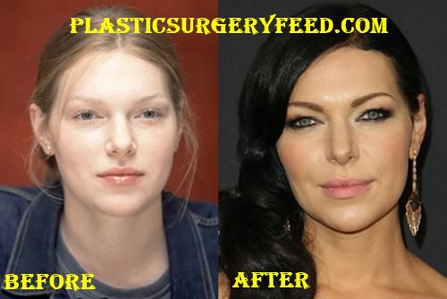 Laura Prepon Lips Implant