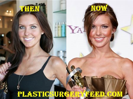 Audrina Patridge Breast Implants