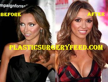 Giuliana Rancic Breast Implants Boob Job