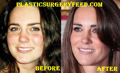 Kate Middleton Botox and Facelift