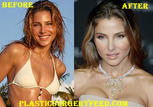 Elsa Pataky Breast Implants