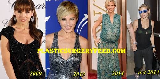 Elsa Pataky Liposuction