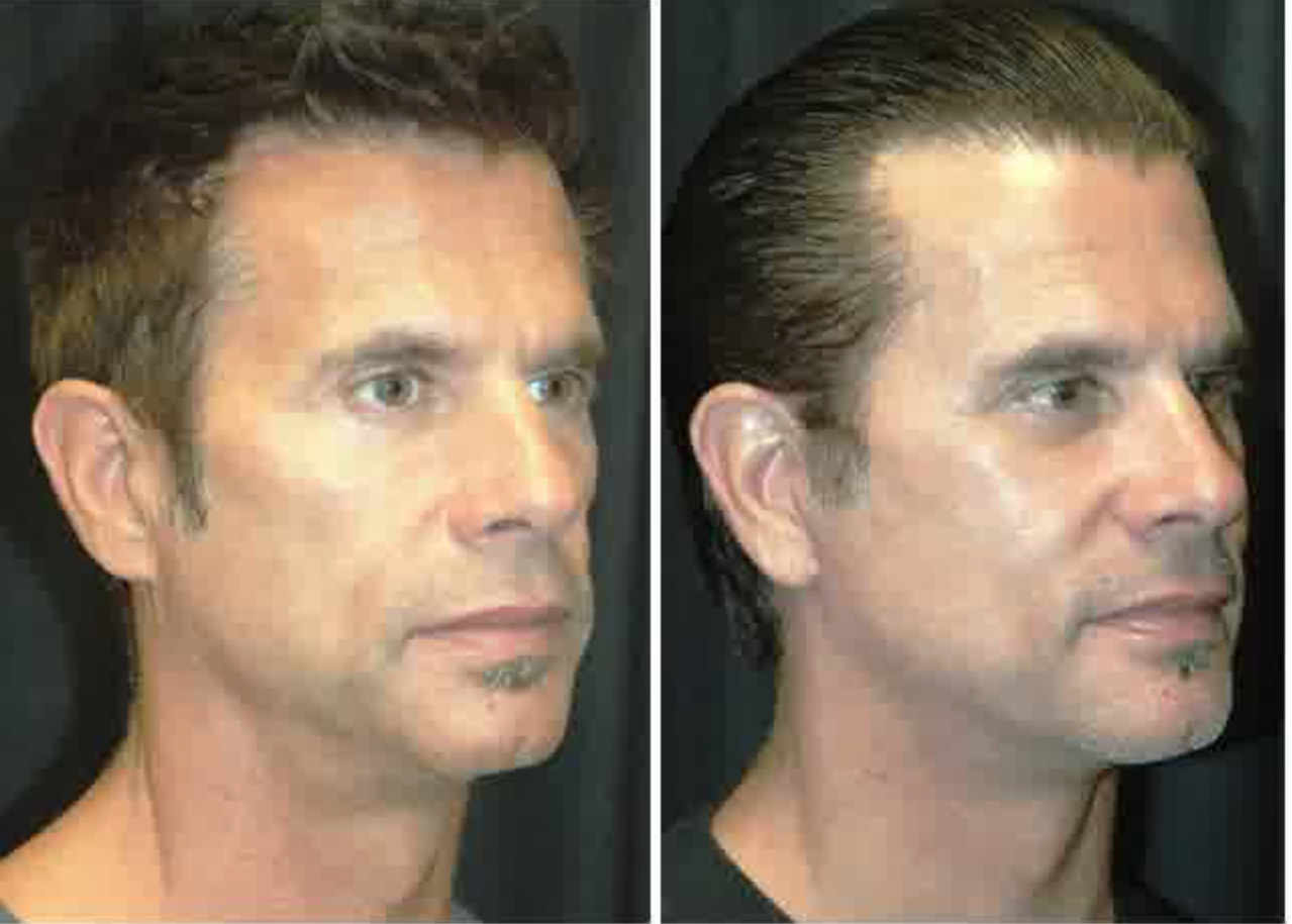 Lorenzo Lamas Facelift