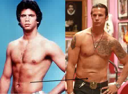 Lorenzo Lamas Liposuction