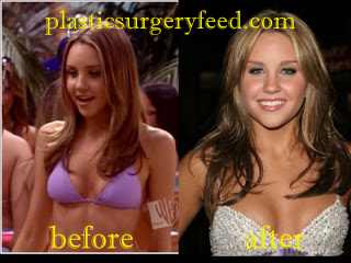 amanda bynes plastic surgery breast