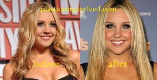 Amanda Bynes Cheek Implant