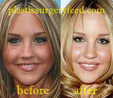 Amanda Bynes Eyelift Surgery