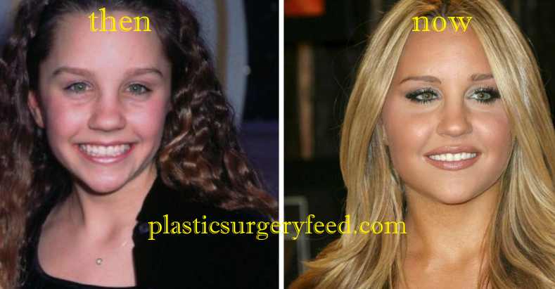 Amanda Bynes Nose Job