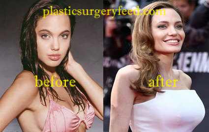 Angelina Jolie Breast Implants