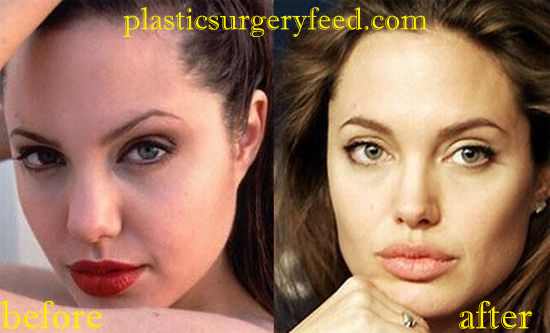 Angelina Jolie Rhinoplasty