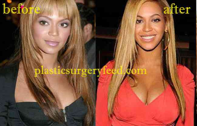 Beyonce Breast implant