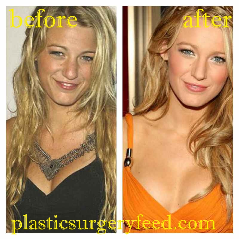 Blake Lively Breast Augmentation