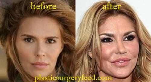 Brandi Glanville Botox