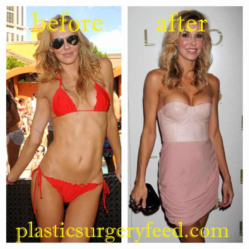 Brandi Passante Breast Implants