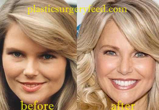 Christie Brinkley Blepharoplasty Eyelid