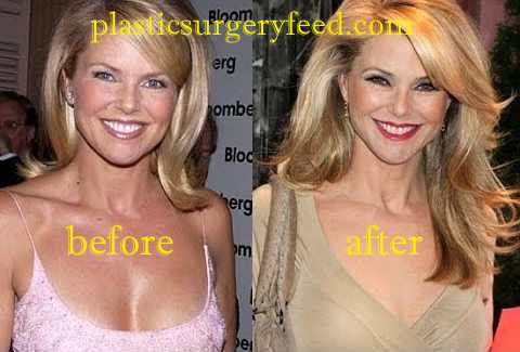 Christie Brinkley Botox anfd Facelift