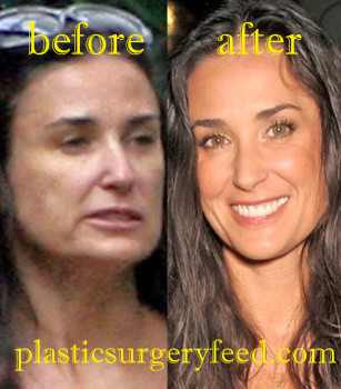 Demi Moore Botox Surgery
