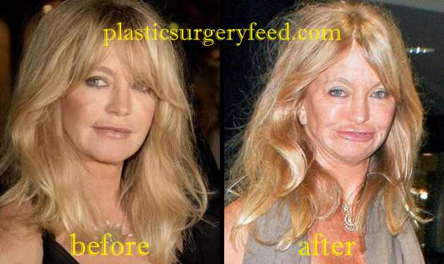 Goldie Hawn Botox and Facelift