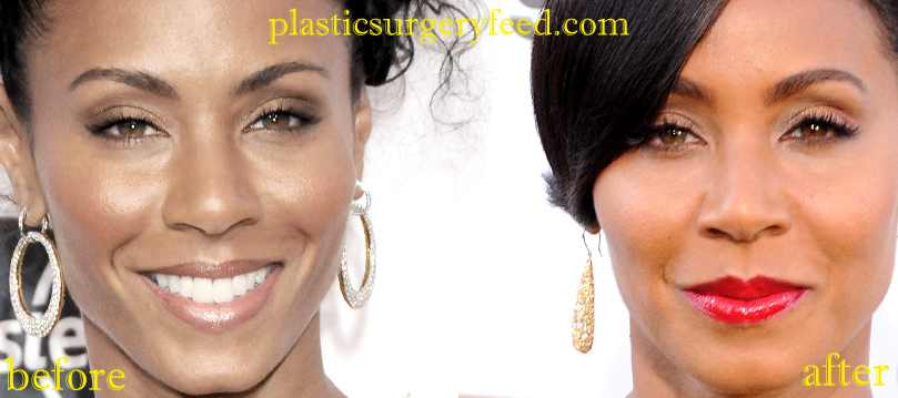 Jada Pinkett Smith Cheek Implant