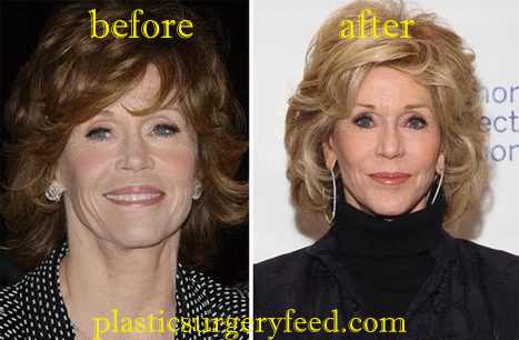 Jane Fonda Facelift