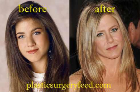 Jennifer Aniston Botox