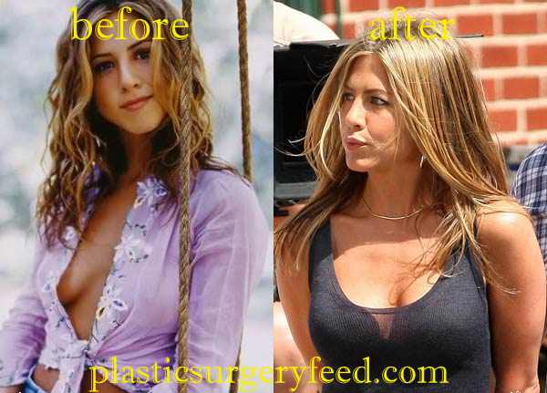 Jennifer Aniston Breast Augmentation