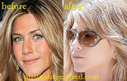 Jennifer Aniston Rhinoplasty