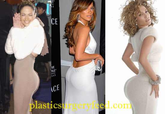 Jennifer Lopez Buttock Implants