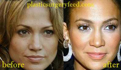 Jennifer Lopez Lips Implant and Botox