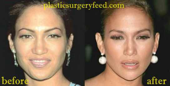 Jennifer Lopez Nose Job